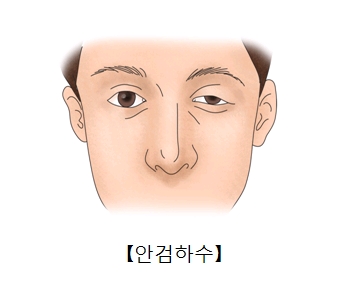 안검하수