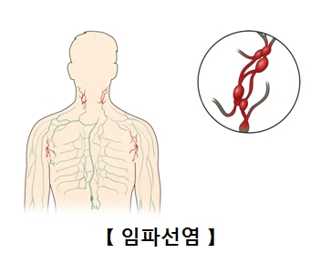 임파선염