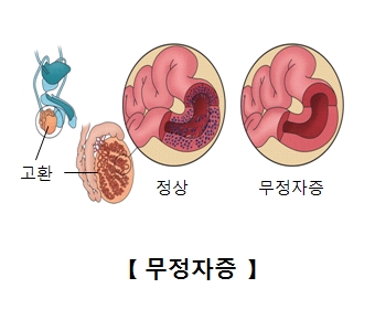 무정자증