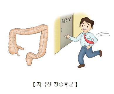 자극성 장 증후군