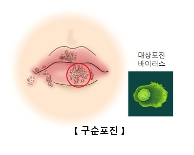 구순포진