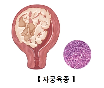 자궁 육종