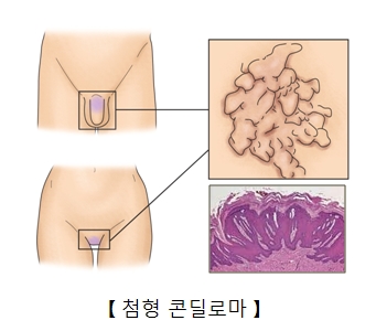 첨형콘딜로마