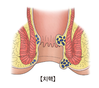 치핵