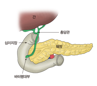 만성 췌장염