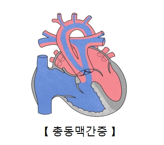 총동맥간증