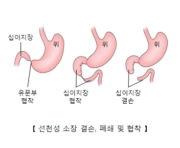 선천성 소장 결손, 폐쇄 및 협착