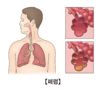 병원 감염성 폐렴