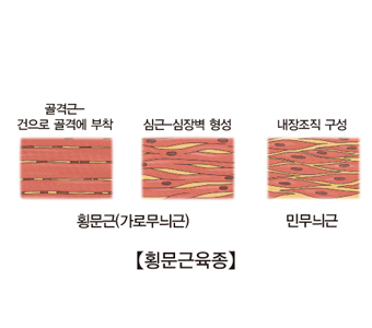 횡문근육종