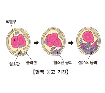 파종성 혈관 내 응고 증후군