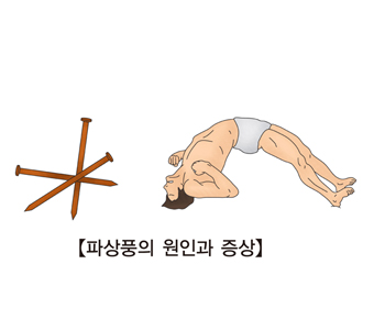 파상풍