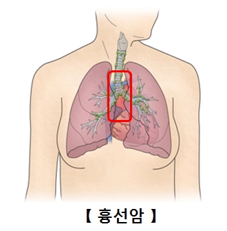 흉선암