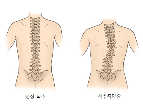 척추측만증