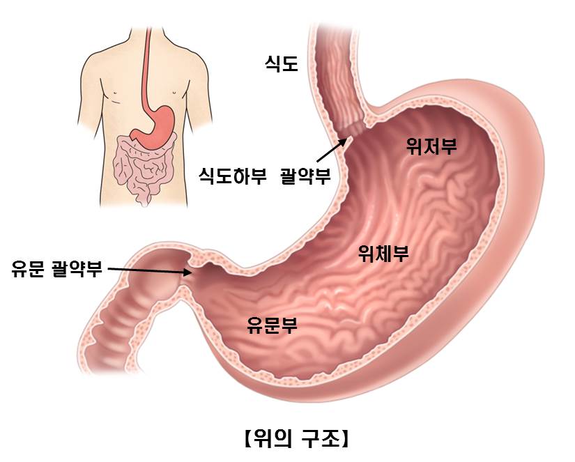 위암