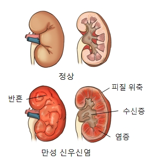 신우신염