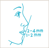 Bimaxillary protrusion